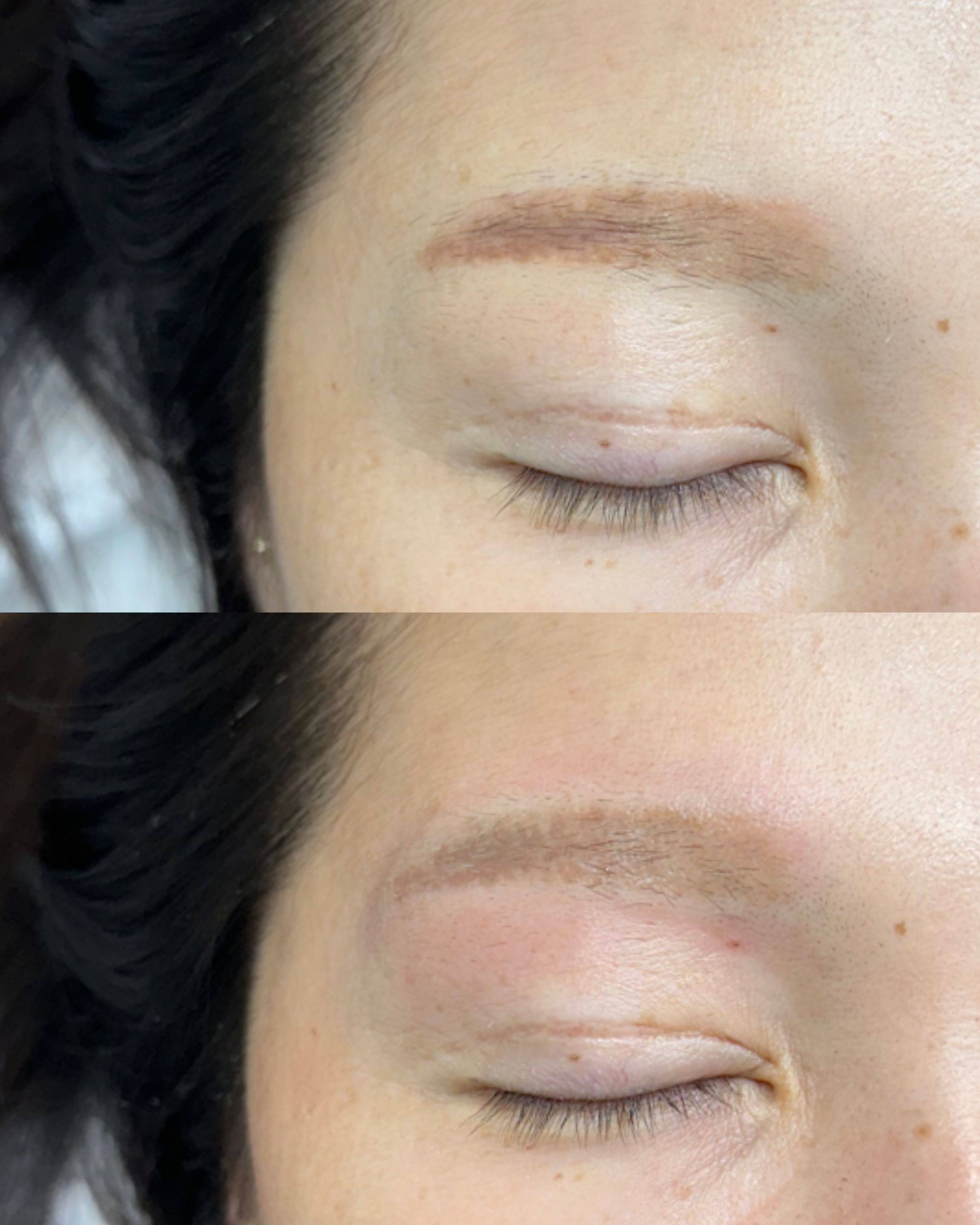 잔흔 제거 시술 사례 1