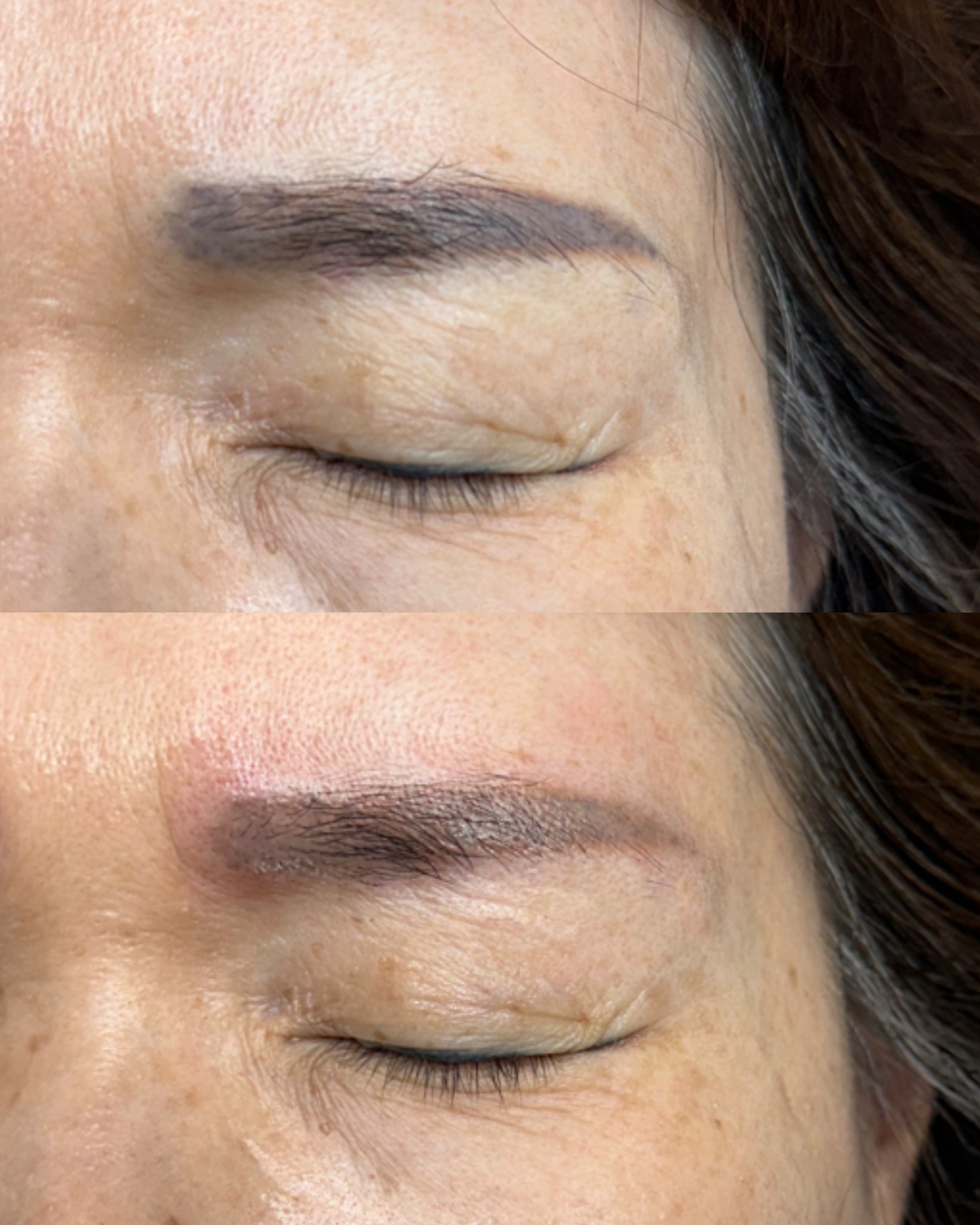 잔흔 제거 시술 사례 2