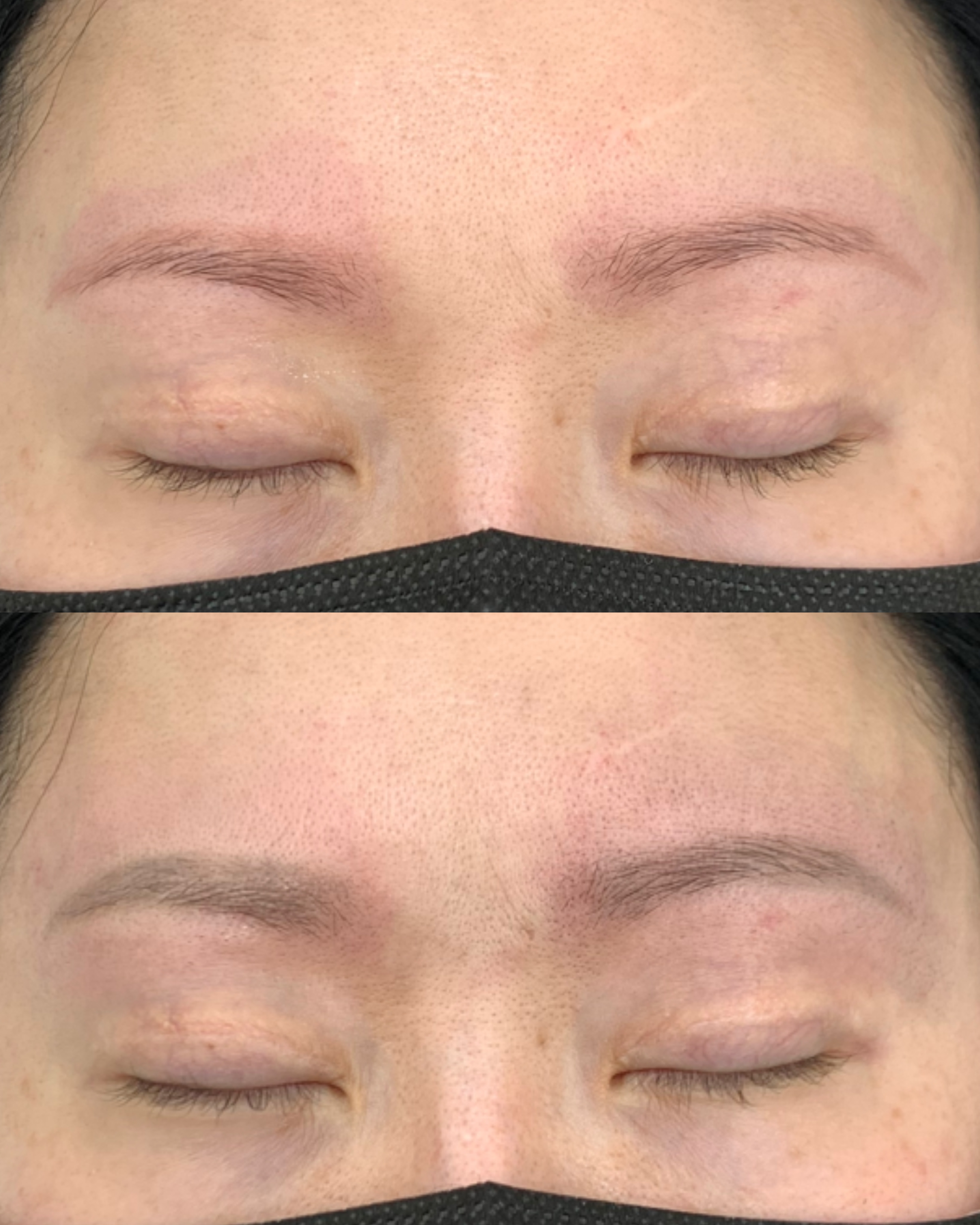 잔흔 제거 시술 사례 3