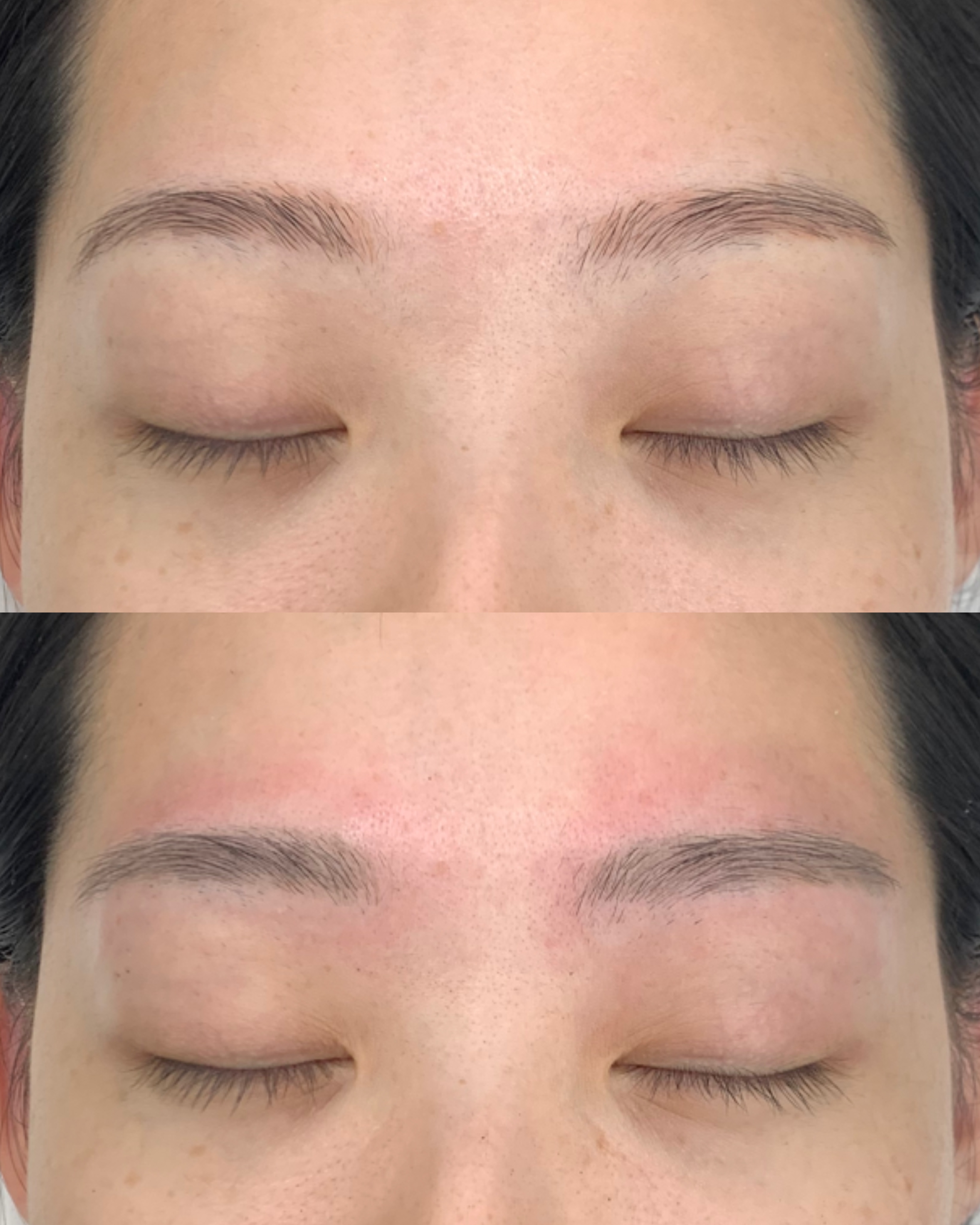 잔흔 제거 시술 사례 4