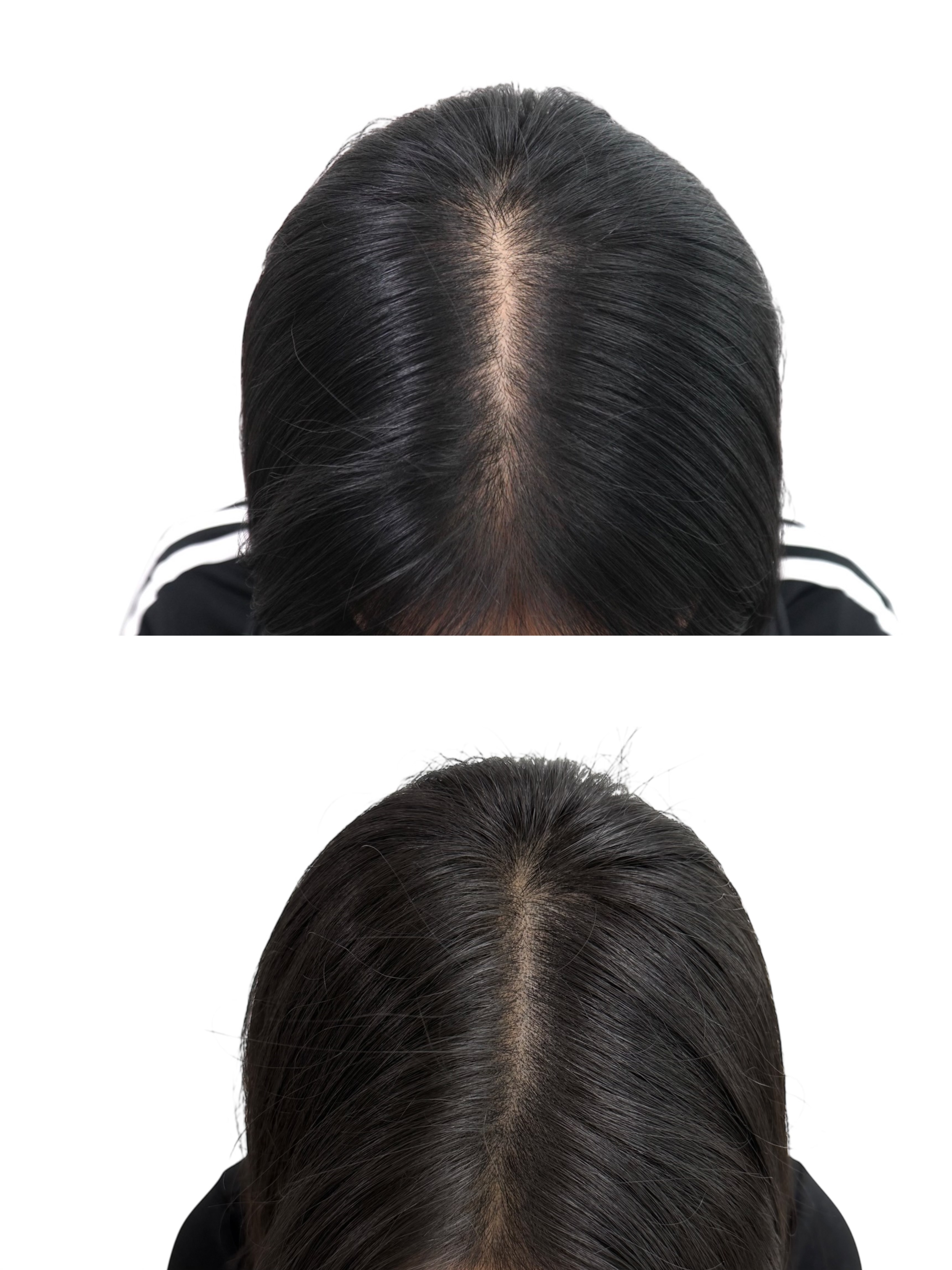 두피 SMP 시술 사례 1