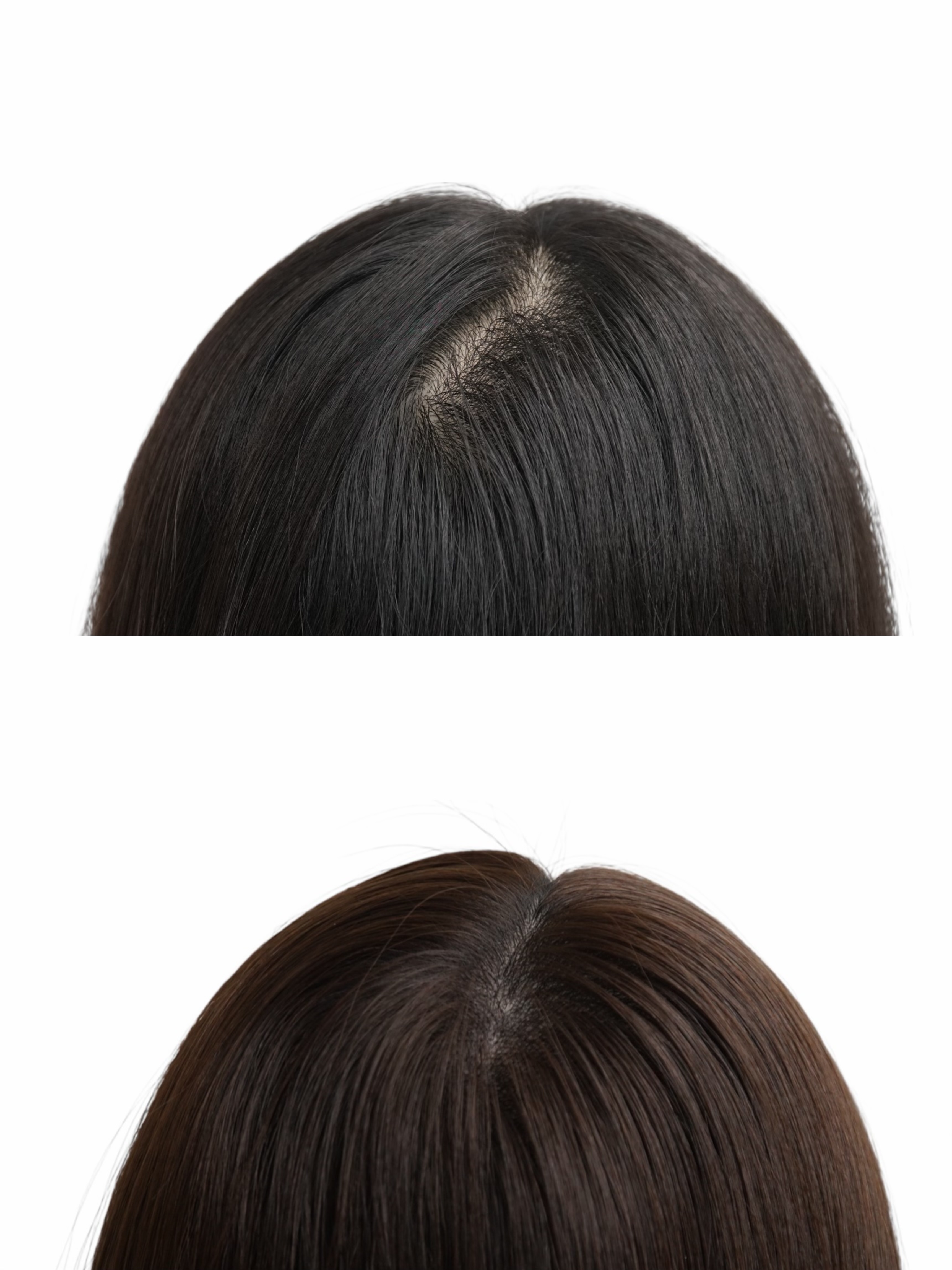 두피 SMP 시술 사례 2