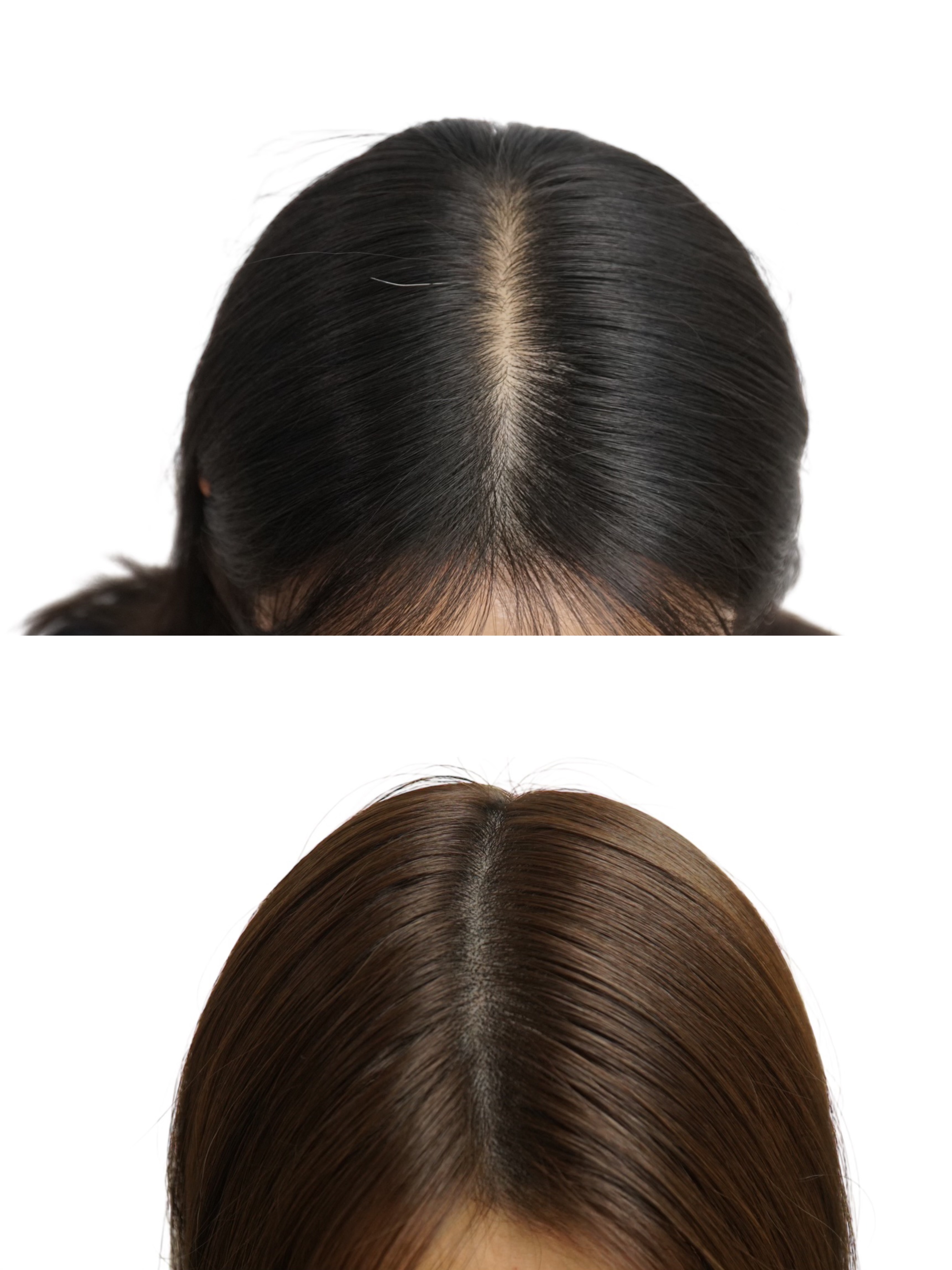 두피 SMP 시술 사례 3