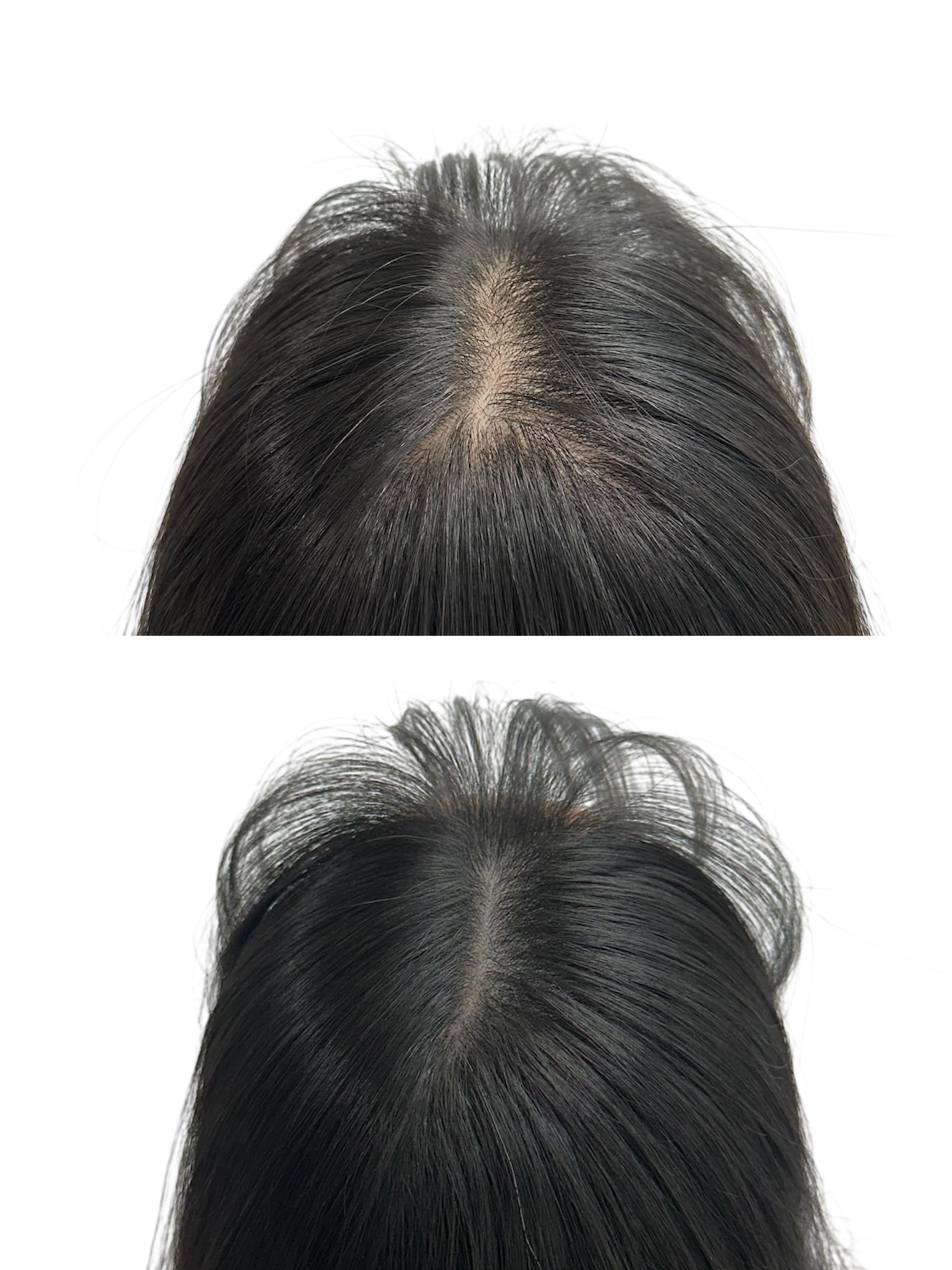 두피 SMP 시술 사례 4