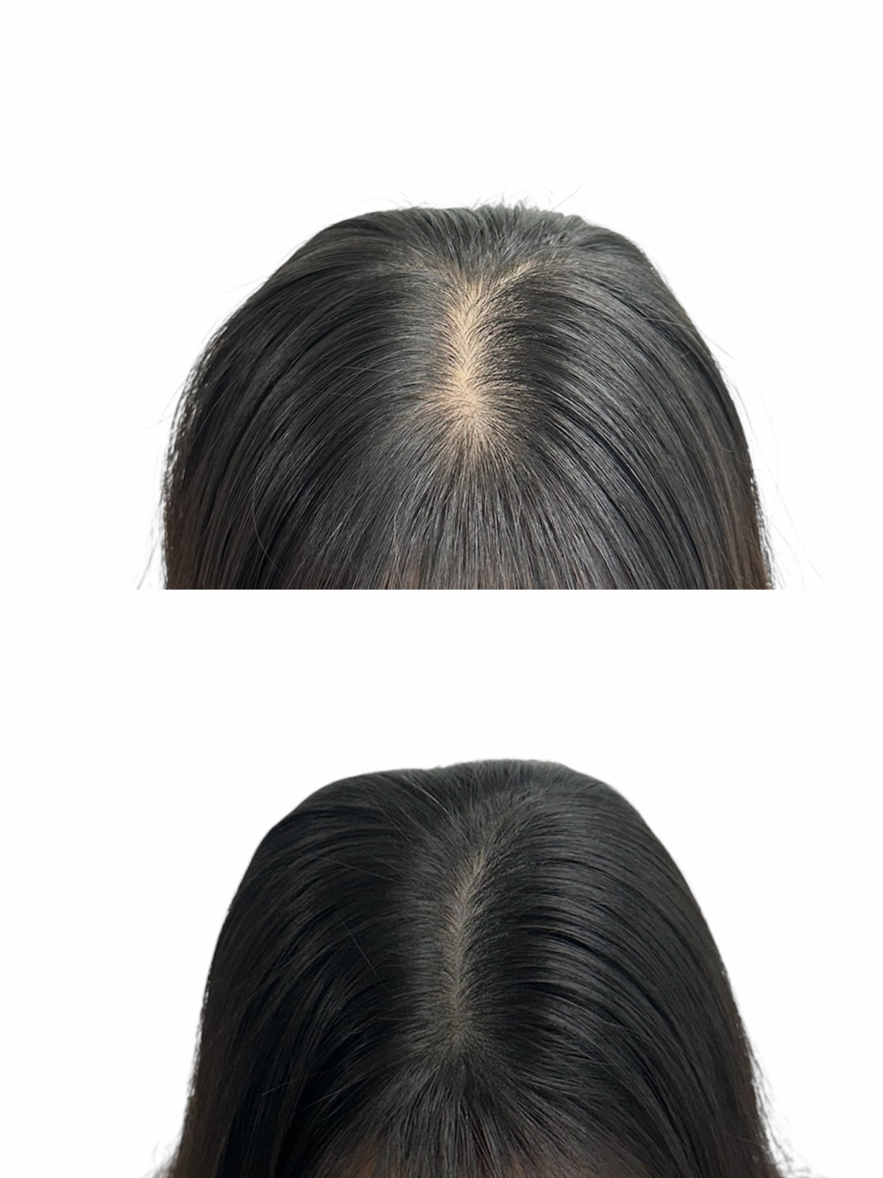 두피 SMP 시술 사례 5